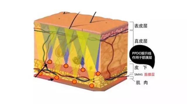 面部埋线提升 预防衰老保童颜